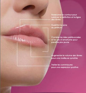 zones d'injection d'acide hyaluronique au niveau des lèvres